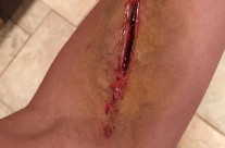 Deep cut in forearm
